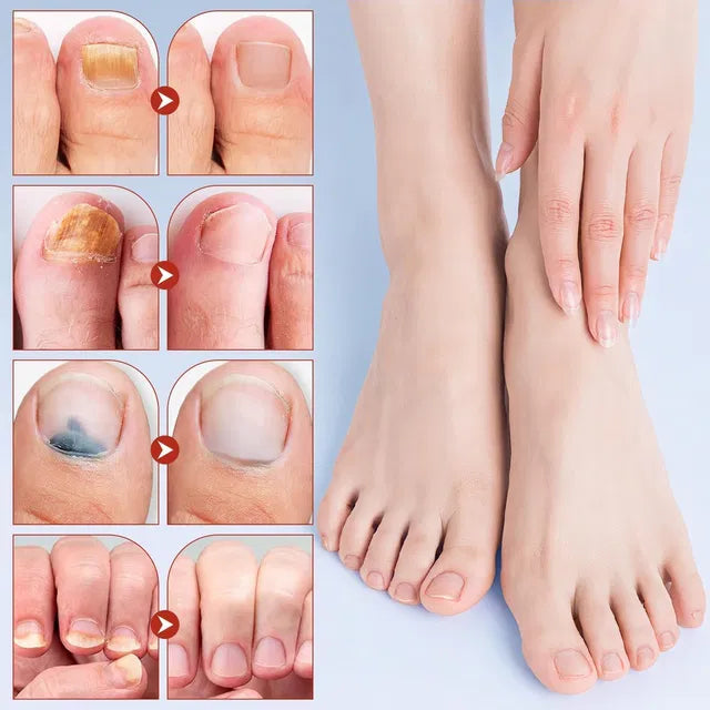 Advanced Fungal Nail Patch – 21 Patches (Pack of 1)